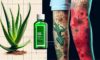 Burn Treatment Essentials: Effective Care Steps Explained